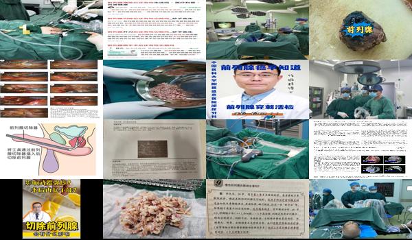 切除前列腺手术的价格 - 汕头前列腺切除严重吗