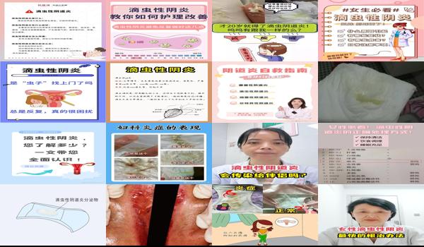 滴虫性鬼头炎图片 - 汕头滴虫性阴炎症状 图片